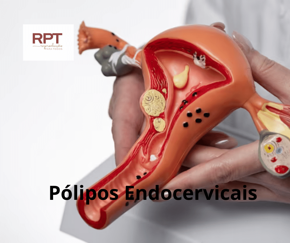 Pólipos Endocervicais